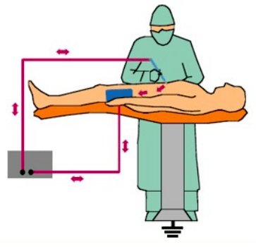 高频手术示意图 高频手术示意图
